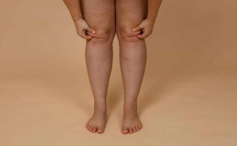 Lipedema: por que tantas mulheres convivem com dor, inchaço e anos de frustração antes do diagnóstico